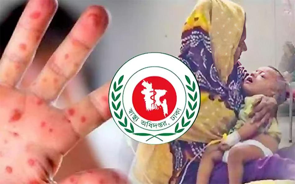 হাম পরিস্থিতি ভয়াবহ